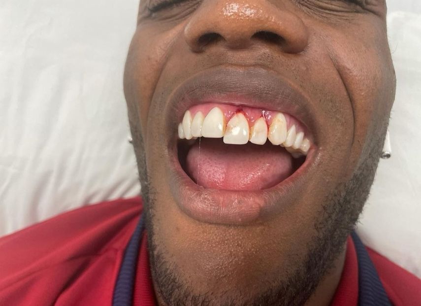 José Fajardo sufrió trauma dental en partido de Panamá ante El Salvador